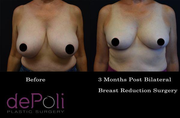 Bilateral Breast Reduction