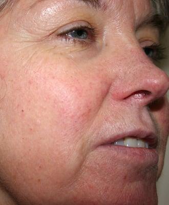 After a series of peels and home treatment