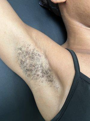 'Before' underarm wax