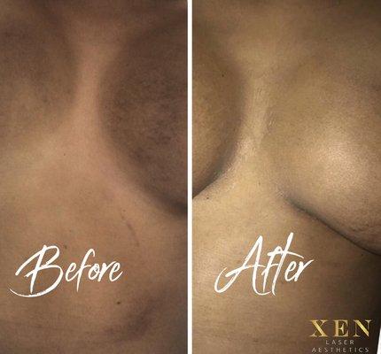 Before and After custom Body Peel to remove chest discoloration and even the skin tone.