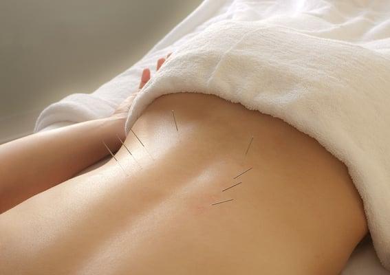 Acupuncture is great for back pain!