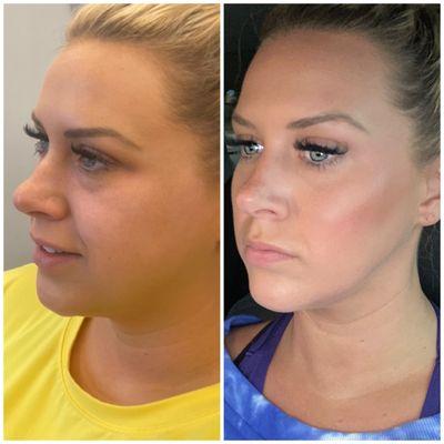 Before on the left and after on the right- filler in cheeks, chin and Botox in forehead