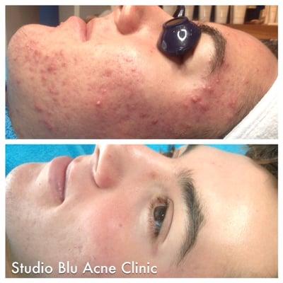 Before/After Studio Blu Acne Clinic