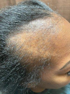 Before! Traction alopecia April