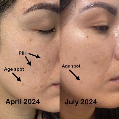 Age spot and pigmentation faded from treatments and professional home care