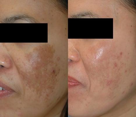 Melasma treatment before and after photos. Using our Celibre Depigmentation program.