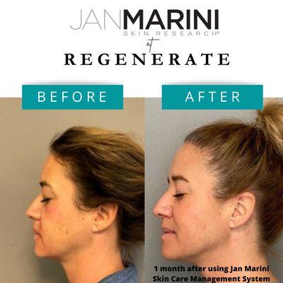 1 month after using Jan Marini Skin Care Management System!