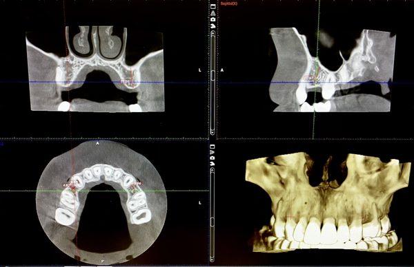 Our cone beam 3D Scanner is beneficial in evaluating our patients for a dental implant.