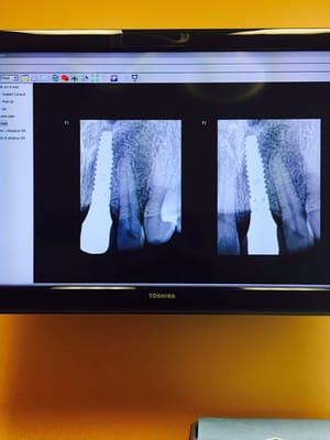 One year follow up X-ray for dental implant on front tooth. Strong, healthy and beautiful