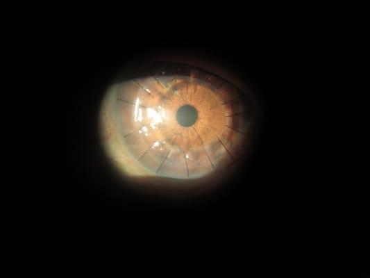 combined cataract extraction with corneal transplant