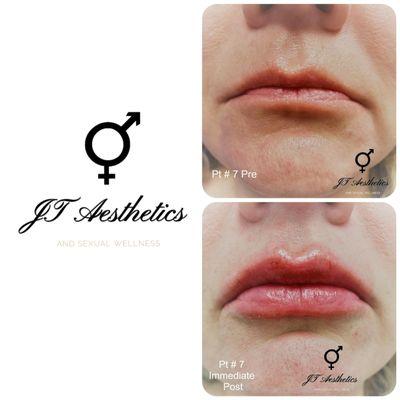 Beautiful results with lip injections by Dr. Jeremy Timmer.