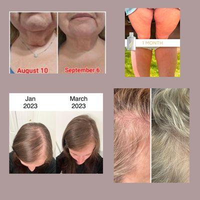 Neck lift natural, thighs firmer, hair loss improved fast