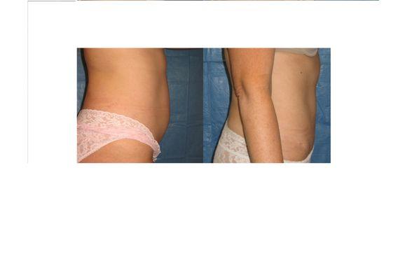 Dr. Perrotti specializes in tummytuck.