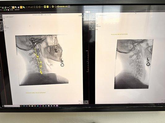 My neck before and after!