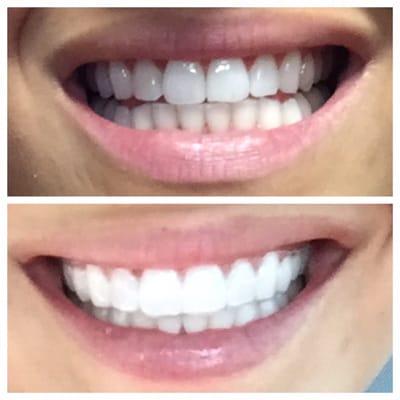 Before and after Zoom 1-hr in office teeth whitening