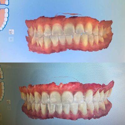 Before & After Invisalign Treatment