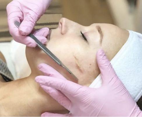 Dermaplaning a cosmetic procedure design to rejuvenate the skin by removing the top layers, including dead cells, oils and fine hairs.