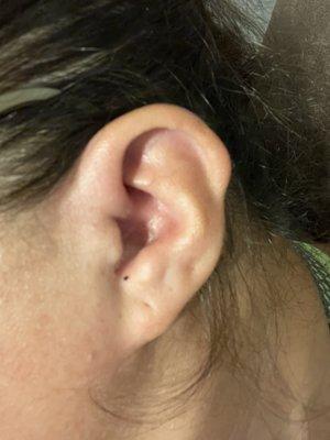 12 Hours After Removal Left Ear