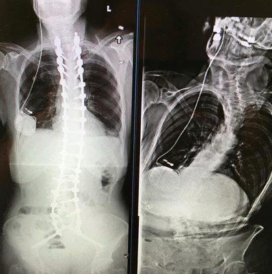 Scoliosis surgery