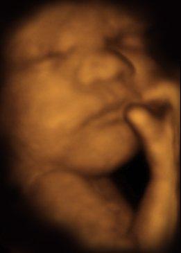 3D Ultrasound Photo