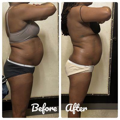 The process of non surgical body contouring is worth it. Fat reduction 360