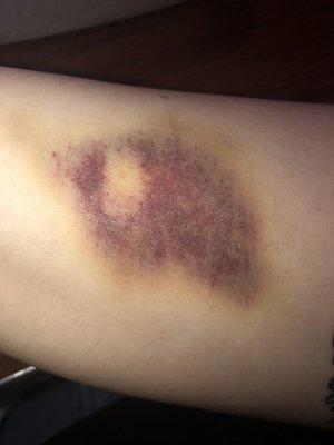 Bruise