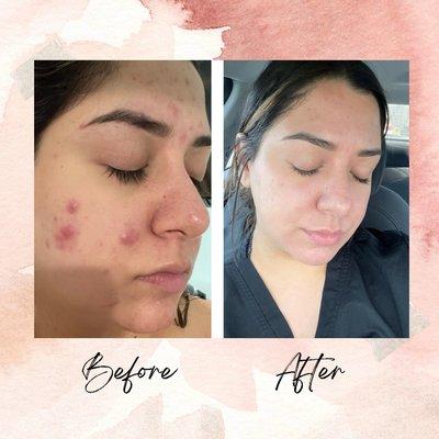 Before and after of my client within 2 months of tailored skincare and 2 facials with me.