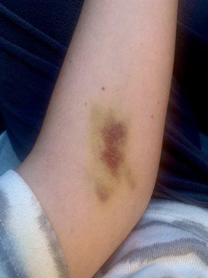 my arm one week after getting ONE TUBE of blood drawn by the male tech there