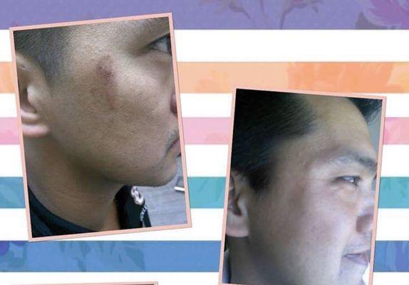 6 Series of Peels| All Ethnicities & Fitz type Skin Expert
#3 treatment after severe wax burn from several years prior