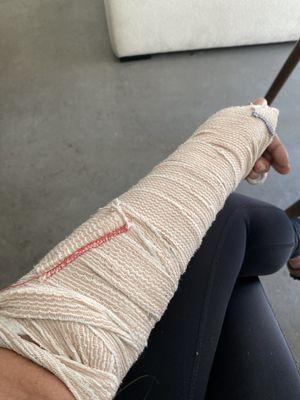 Broken arm