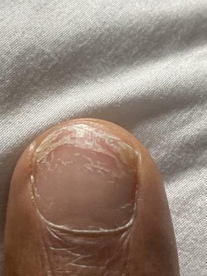 Toe nail