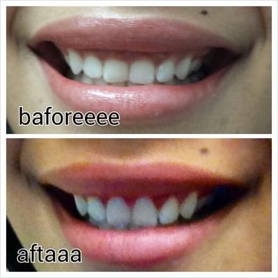 Before and after crown lengthening. Notice the curvature of the top of the teeth and how much bigger they are. Huge difference!