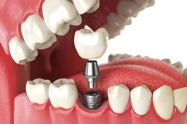 IMPLANT RESTORATIONS