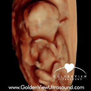 HDLive Ultrasound of baby at 15 weeks captured at GoldneView Ultrasound