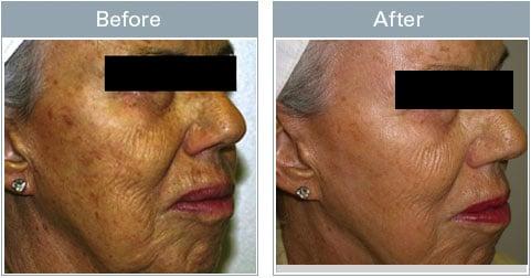 Facial Firming Treatment LHE Lightens Skin tone, decreases wrinkles, Skin Tightening and Skin Rejuvenation