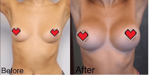 Patient received  breast implants of 339 CC's