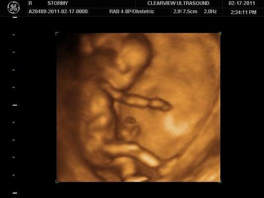 Ultrasound at 15 weeks.  Further along is when the baby starts to get chubby cheeks and look more like a baby