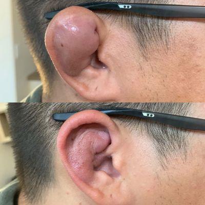 Ear drainage