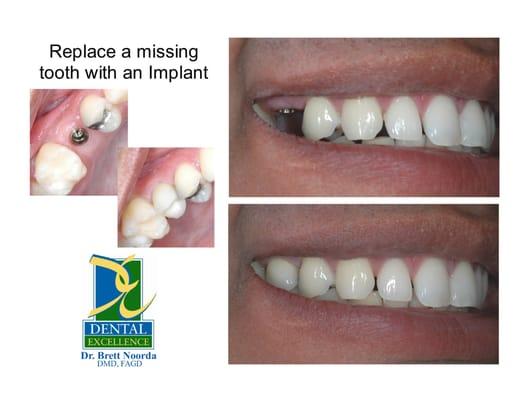 Implant, Dental Implant