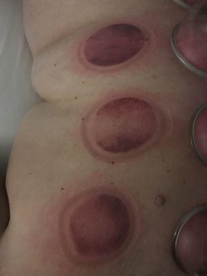 Cupping Massage