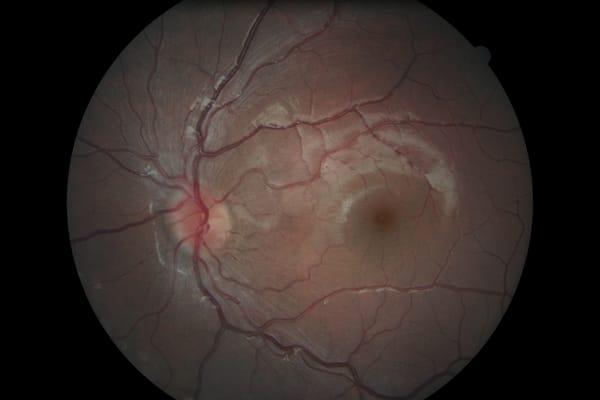 Inside of Left eye - Fundus Photo