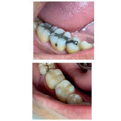 Transformation Thursday! From silver fillings to white fillings! We give all our patients white fillings!