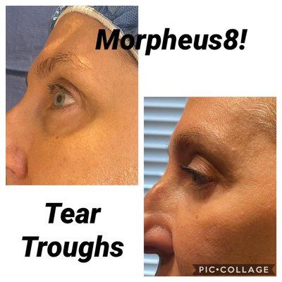 Morpheus 8 tear troughs correction. Minimally invasive, no fillers needed!