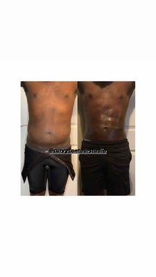 Before and after pic of a client who has had lymphatic drainage massages.