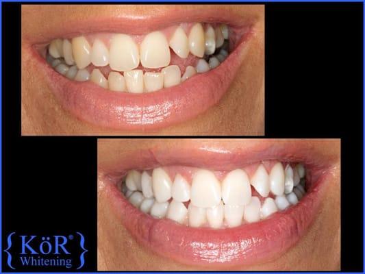 Teeth Whitening using the Kor whitening system.