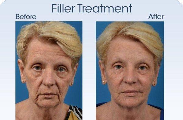 Before & After Liquid Facelift by Premier Expert Injector, Brian Benson, PA-C