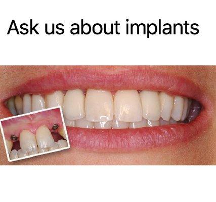 Implant Placement & Restorations