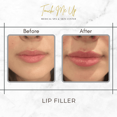 Lip Filler Before|After