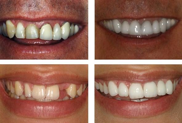 before and after photos of mini dental implants.