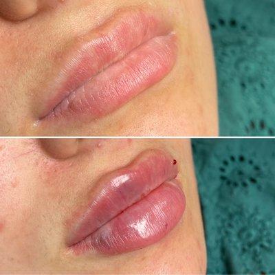 Lips augmentation